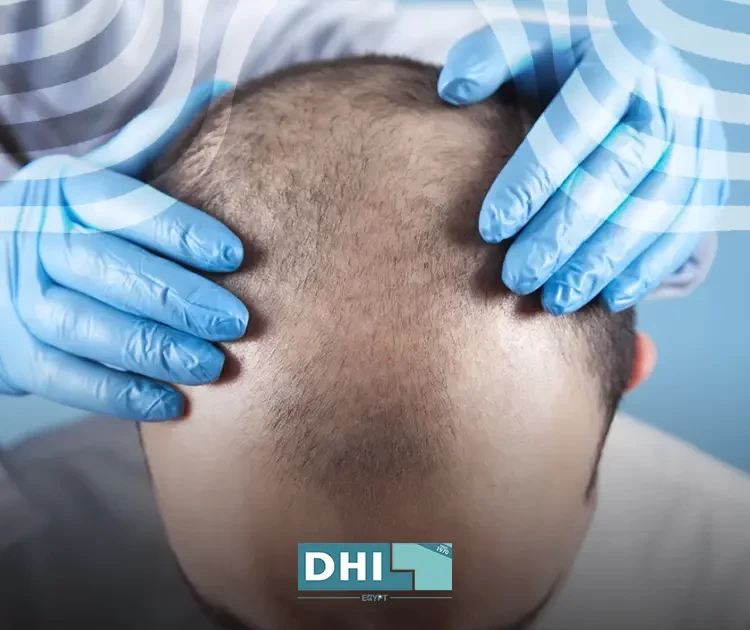 زراعة الشعر في مصر للرجال