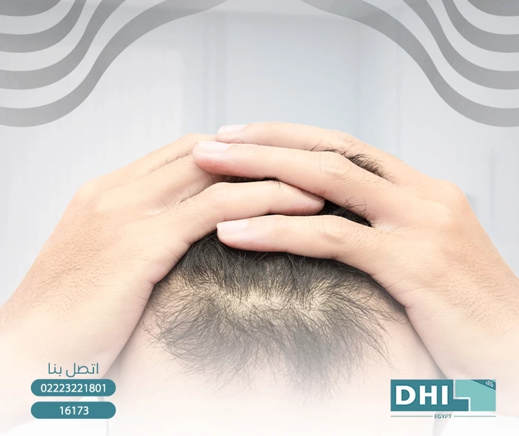 تكلفة حقن بلازما للشعر