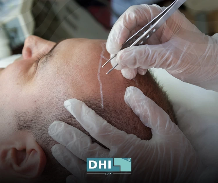 Hair Transplant Before and After