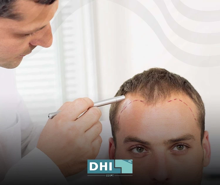 best hair transplant procedure