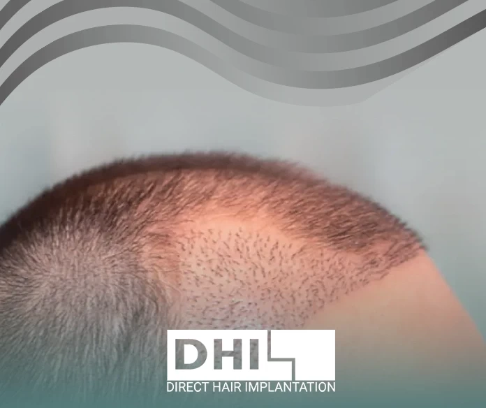 زراعة شعر