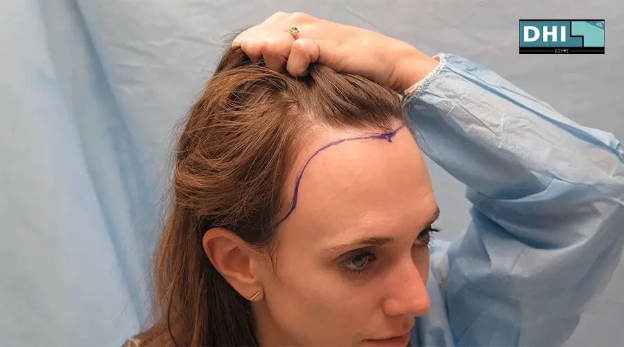 زراعة الشعر للبنات