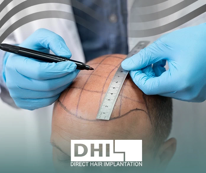 اضرار زراعة الشعر