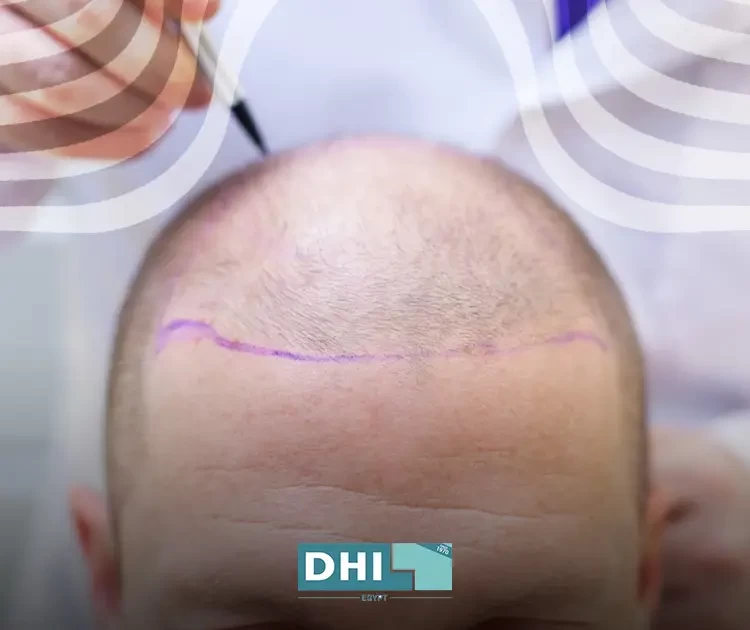 اشهر دكتور زراعة شعر فى مصر