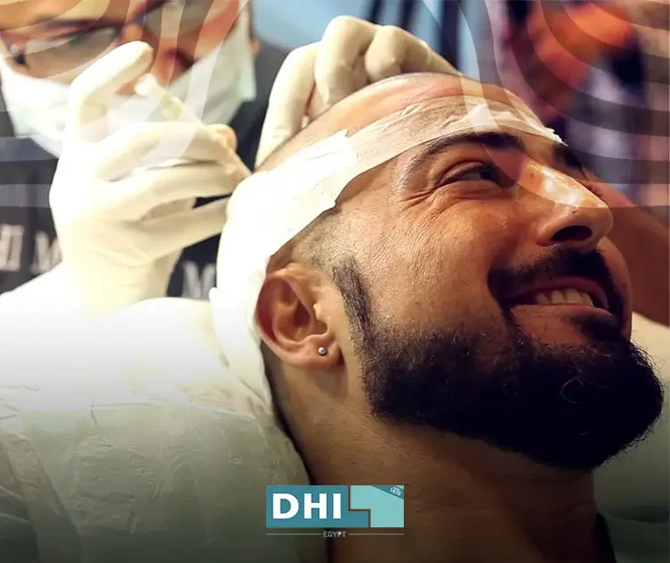 زراعة الشعر بتقنية استنساخ الخلايا الجذعية