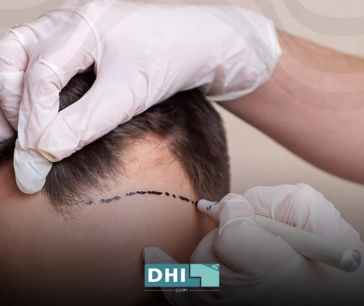 how safe is hair transplant