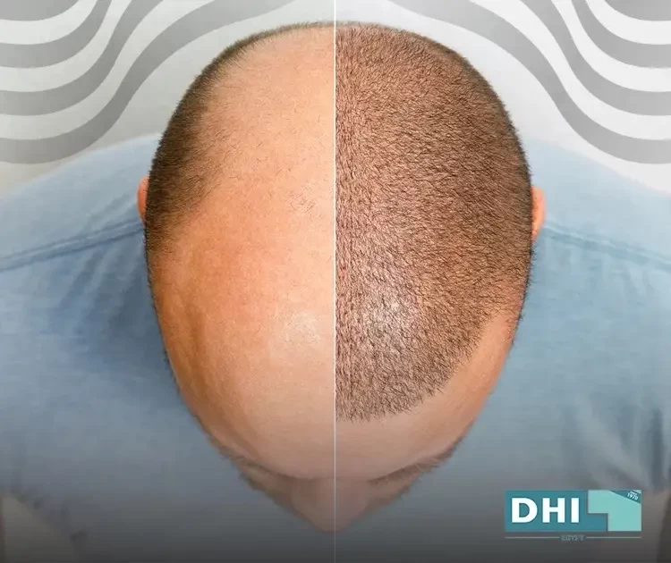 fue hair transplant egypt