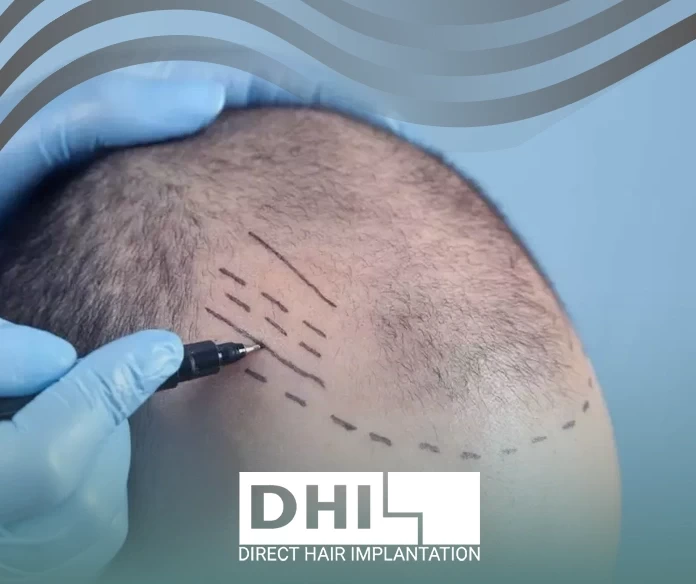 طريقة زراعة الشعر