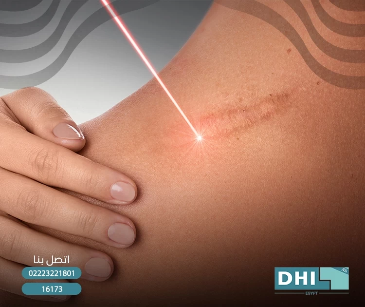 علاج الندبات الجراحية